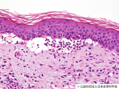 資料2 水疱性類天疱瘡の顕微鏡検査所見