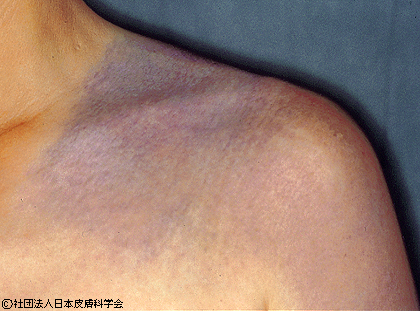 資料6:伊藤母斑