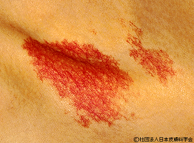 資料17：単純性血管腫