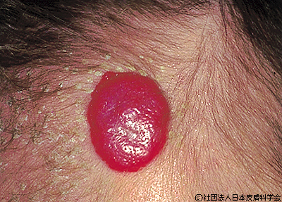 資料18：イチゴ状血管腫