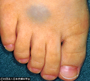 資料19：海綿状血管腫