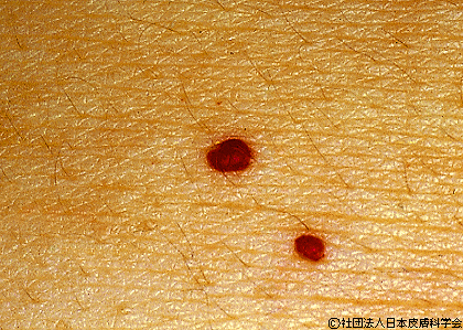 資料23：老人性血管腫
