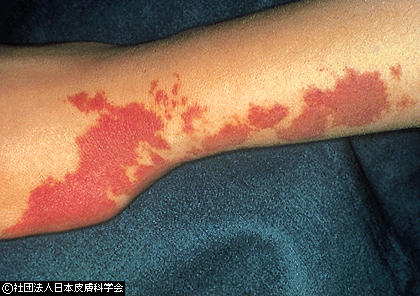資料25:単純性血管腫
