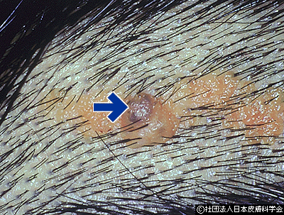 資料29:脂腺母斑の上に生じた毛芽細胞腫(矢印)という皮膚腫瘍