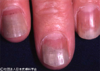 66歳、女性。原因不明。