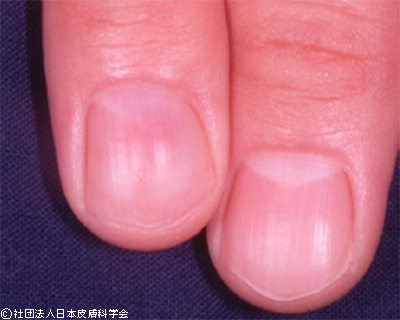 薬指爪甲の中央付近が少し赤くなり、腫れています。この部分にグロムス腫瘍を認め、摘出した。その後、疼痛は消失した。