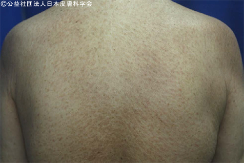 ニッケルによる全身性接触皮膚炎(健康食品のひえに含まれるニッケルが原因となり発症しました)