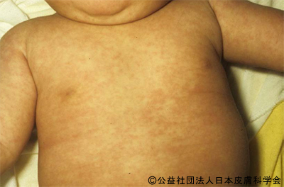 乳児例 高熱が続き、解熱とほぼ同時に体幹に丘疹、紅斑が出ます
