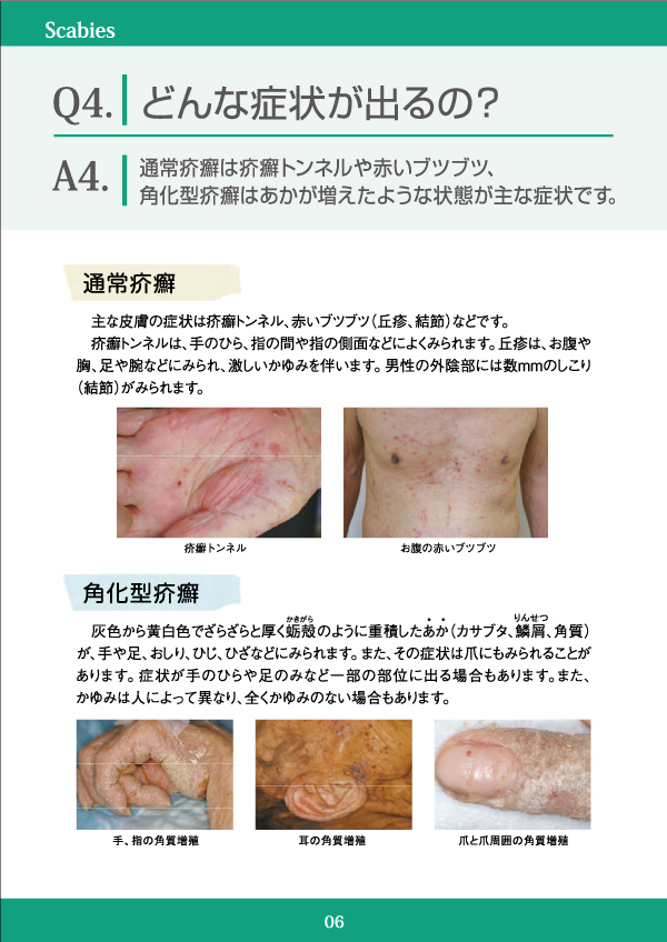 どんな症状が出るの？