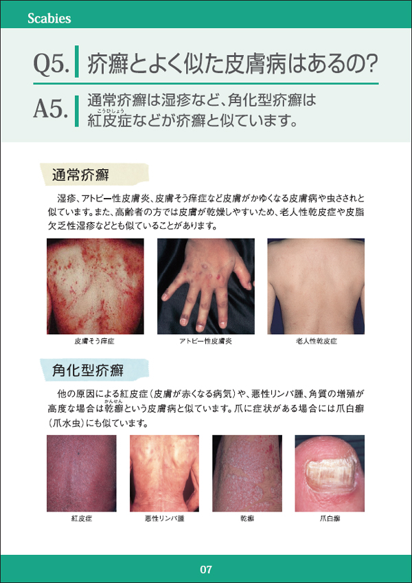 疥癬とよく似た皮膚病はあるの？
